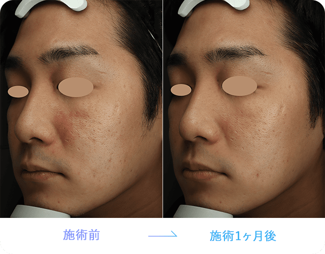 水光注射 水光注射（HYCOOX・Vital Injector） | 美容整形外科のジョウ