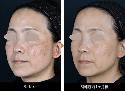 シルファームX｜美容皮膚科なら湘南美容クリニック【公式】