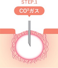 トライフィルプロの仕組み STEP2