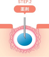 トライフィルプロの仕組み STEP3