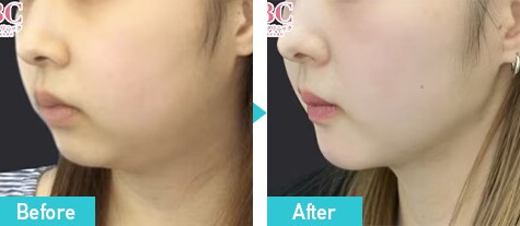 脂肪吸引注射　症例写真　ビフォーアフター