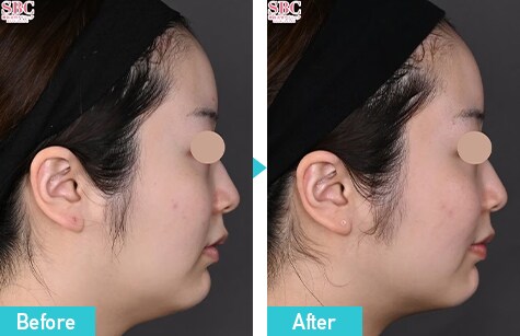 新・脂肪溶解リニアハイフ　症例写真　ビフォーアフター
