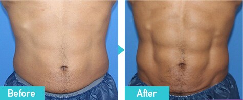 トゥルースカルプflex　症例写真　ビフォーアフター