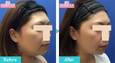 BNLS アルティメット　症例写真　ビフォーアフター