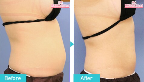 医療ダイエット（ダイエット外来）・部分痩せなら湘南美容クリニック 