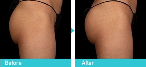 トゥルースカルプflex　症例写真　ビフォーアフター