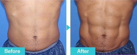 トゥルースカルプflex　症例写真　ビフォーアフター