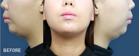 脂肪溶解注射 Bnls アルティメット 医療ダイエットなら湘南美容クリニック 公式 脂肪溶解注射 Bnls アルティメット 医療ダイエットなら湘南美容クリニック 公式