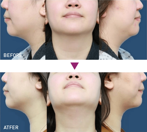 脂肪溶解注射 BNLS アルティメット（小顔注射）の症例写真2 ビフォーアフター