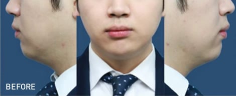 脂肪溶解注射 Bnls アルティメット 医療ダイエットなら湘南美容クリニック 公式 脂肪溶解注射 Bnls アルティメット 医療ダイエットなら湘南美容クリニック 公式