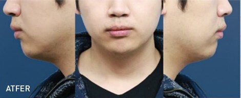 脂肪溶解注射 Bnls アルティメット 医療ダイエットなら湘南美容クリニック 公式 脂肪溶解注射 Bnls アルティメット 医療ダイエットなら湘南美容クリニック 公式