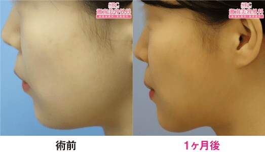 脂肪溶解注射 Bnls Neo 医療ダイエット 部分瘦せなら湘南美容クリニック 公式 脂肪溶解注射 Bnls Neo 医療ダイエット 部分瘦せなら湘南美容クリニック 公式