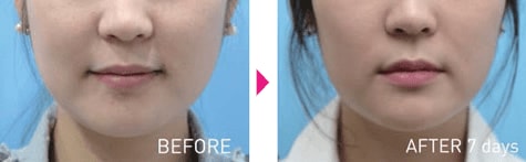 脂肪溶解注射 Bnls Neo 医療ダイエットなら湘南美容クリニック 公式 脂肪溶解注射 Bnls Neo 医療ダイエットなら湘南美容クリニック 公式