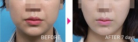 脂肪溶解注射 Bnls Neo 医療ダイエットなら湘南美容クリニック 公式 脂肪溶解注射 Bnls Neo 医療ダイエットなら湘南美容クリニック 公式