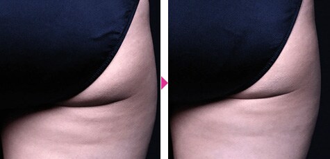{臀部}　{プロショックシェイプ}｛症例写真 before after｝