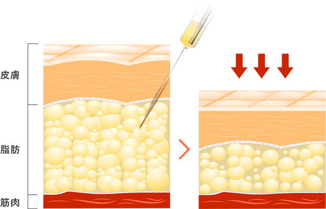 脂肪溶解注射 イメージ
