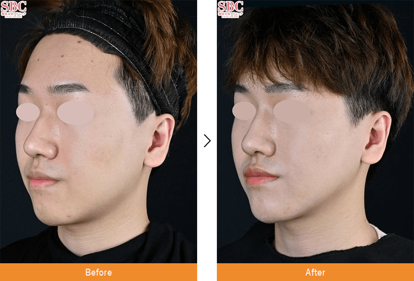 新・脂肪溶解リニアHIIFU×山参注射 症例写真