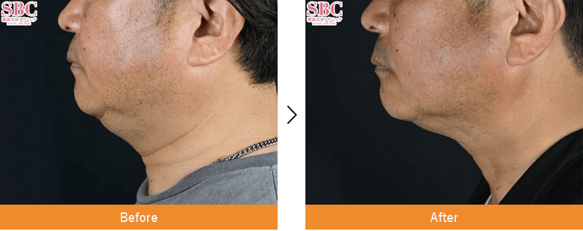 クールスカルプティング×山参注射 症例写真