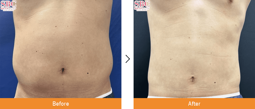 クールスカルプティング×山参注射 症例写真