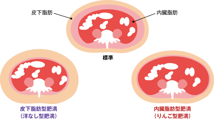 皮下脂肪型肥満と内臓脂肪型肥満