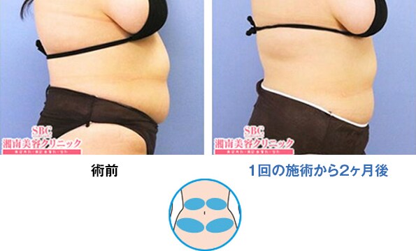 PickUp症例写真2 腹部 1回の施術から2ヶ月後 n192267