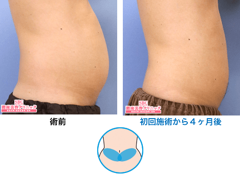 症例写真 腹 初回施術から4ヶ月後