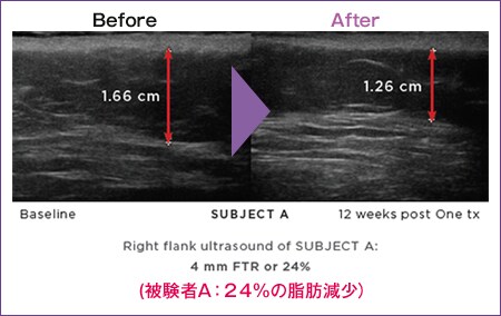 被験者A：24％の脂肪減少