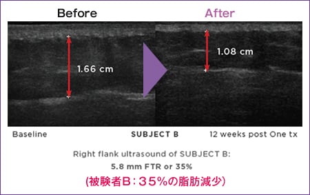 被験者B：35％の脂肪減少