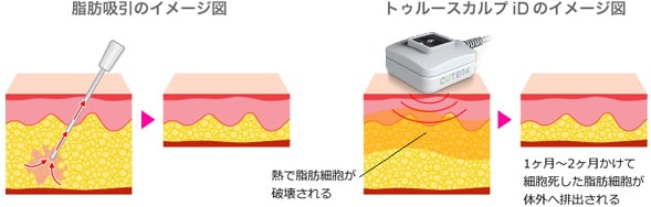 脂肪吸引との違い 画像