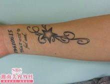 タトゥー(刺青・入れ墨)除去　ピコレーザー　症例写真⑪　ビフォーアフター