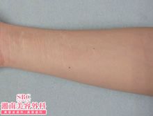 タトゥー(刺青・入れ墨)除去　ピコレーザー　症例写真⑪　ビフォーアフター