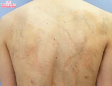 タトゥー(刺青・入れ墨)除去　ピコレーザー　症例写真⑩　ビフォーアフター