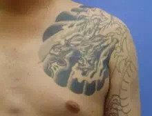 タトゥー(刺青・入れ墨)除去　ピコレーザー　症例写真⑭　ビフォーアフター