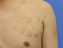 タトゥー(刺青・入れ墨)除去　ピコレーザー　症例写真⑭　ビフォーアフター