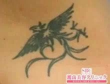 タトゥー(刺青・入れ墨)除去　ピコレーザー　症例写真⑫　ビフォーアフター