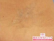 タトゥー(刺青・入れ墨)除去　ピコレーザー　症例写真⑫　ビフォーアフター