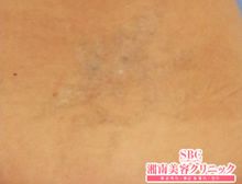 タトゥー(刺青・入れ墨)除去　ピコレーザー　症例写真⑫　ビフォーアフター