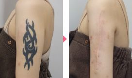 タトゥー(刺青・入れ墨)除去　症例写真⑧　ビフォーアフター