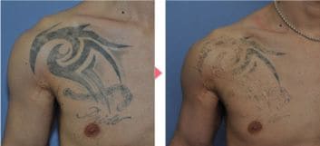 刺青 タトゥー 除去なら湘南美容クリニック 公式 美容整形 美容外科