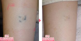 タトゥー(刺青・入れ墨)除去　症例写真④　ビフォーアフター