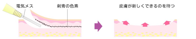 電気メス施術イラスト
