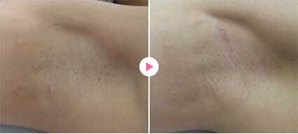 シェービング法でのワキガ・多汗症治療の症例写真