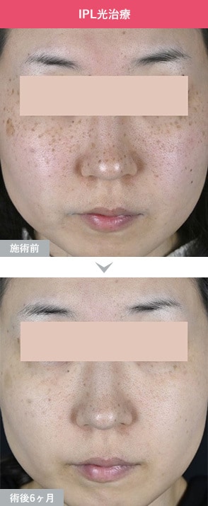 症例写真1