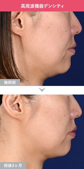 デンシティ 症例写真Before After