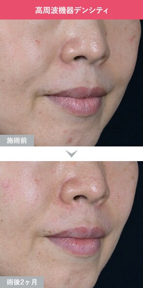 デンシティ 症例写真Before After