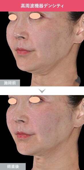 デンシティ 症例写真Before After