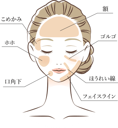 こめかみ ホホ 広角下 額 ゴルゴ ほうれい線 フェイスライン