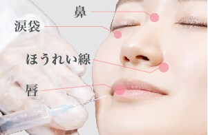 ヒアルロン酸注入		