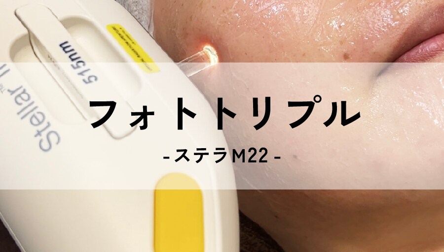 ダウンタイムが少ないシミ治療<br />
「フォトトリプル-ステラM22-」