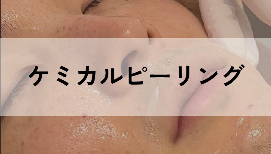 マイルドなピーリングで肌トラブル改善<br />
「ケミカルピーリング」